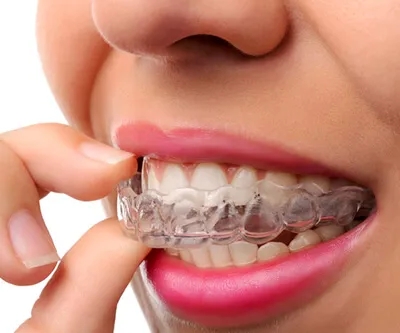 Dream Smile Center Invisalign